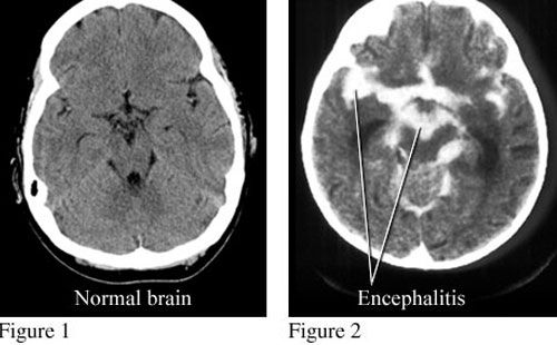 এনসেফালাইটিস কী? 