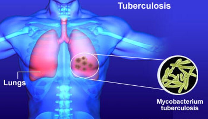 ক্রাশ ডায়েট বাড়িয়ে দেয় যক্ষ্মার সম্ভবনা, জানাচ্ছেন চিকিত্‍সকরা 