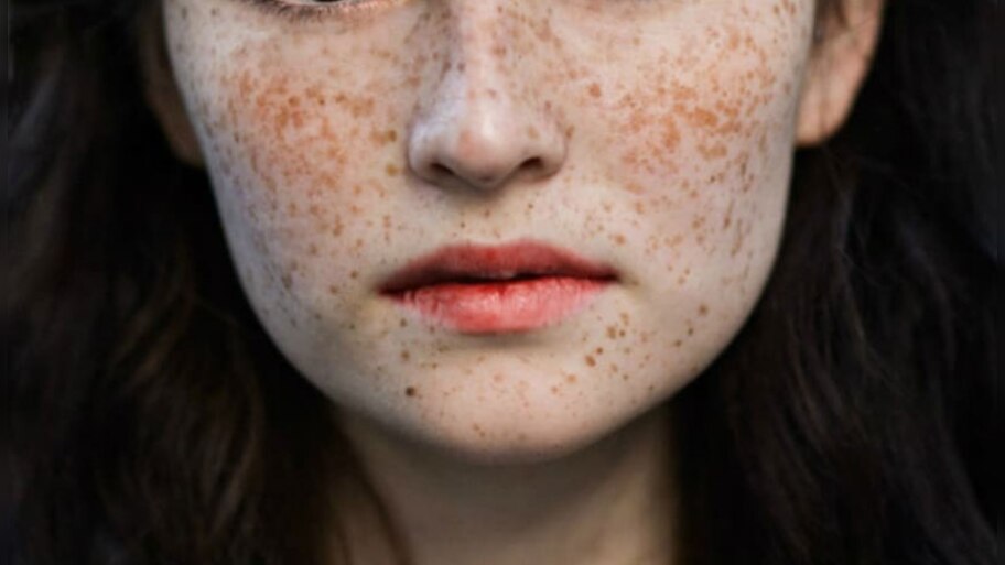 Effective home remedies to cure Urticaria naturally