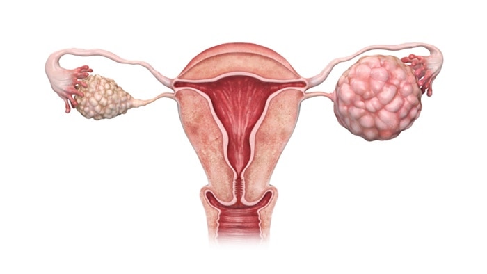 কেন হয় পলিসিস্টিক ওভারিয়ান ডিসিজ?