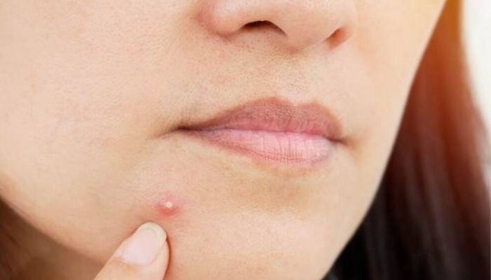 Treats acne 