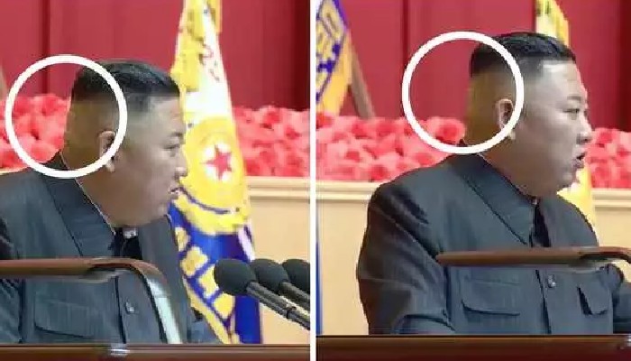 Kim Jong Un: কিমের ঘাড়ে কীসের ক্ষতচিহ্ন? বাড়ছে রহস্য