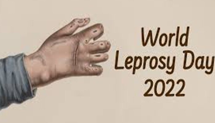 World Leprosy Day: মর্যাদাবোধে বেঁধে বেঁধে থাকা; রোগকে পরাস্ত করাই লক্ষ্য