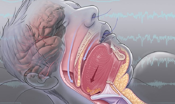 Breathing Trouble In Sleep