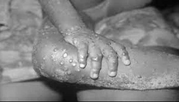 Monkeypox outbreak: করোনা আতঙ্কের মধ্যেই নয়া ত্রাস মাঙ্কি ভাইরাস! কতটা ভয়ানক?