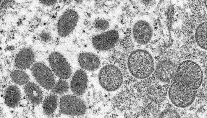 Monkeypox Virus: ইউরোপে বাড়ছে মাঙ্কিপক্স প্রকোপ, ভারতের জন্য কতটা উদ্বেগের?