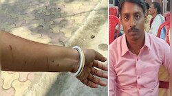 পরকীয়ায় বাধা, স্ত্রীকে অ্যাসিড দিয়ে পুড়িয়ে খুনের চেষ্টা সিভিক পুলিসকর্মী স্বামীর