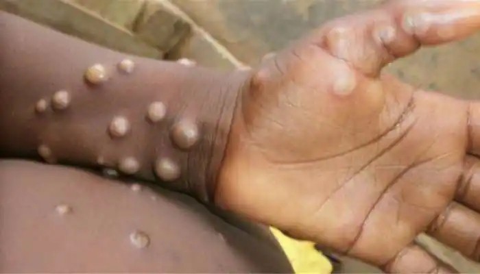 Monkeypox: Tomato Flu-র মাঝেই Monkeypox-র আতঙ্ক, কতটা প্রস্তুত ভারত?