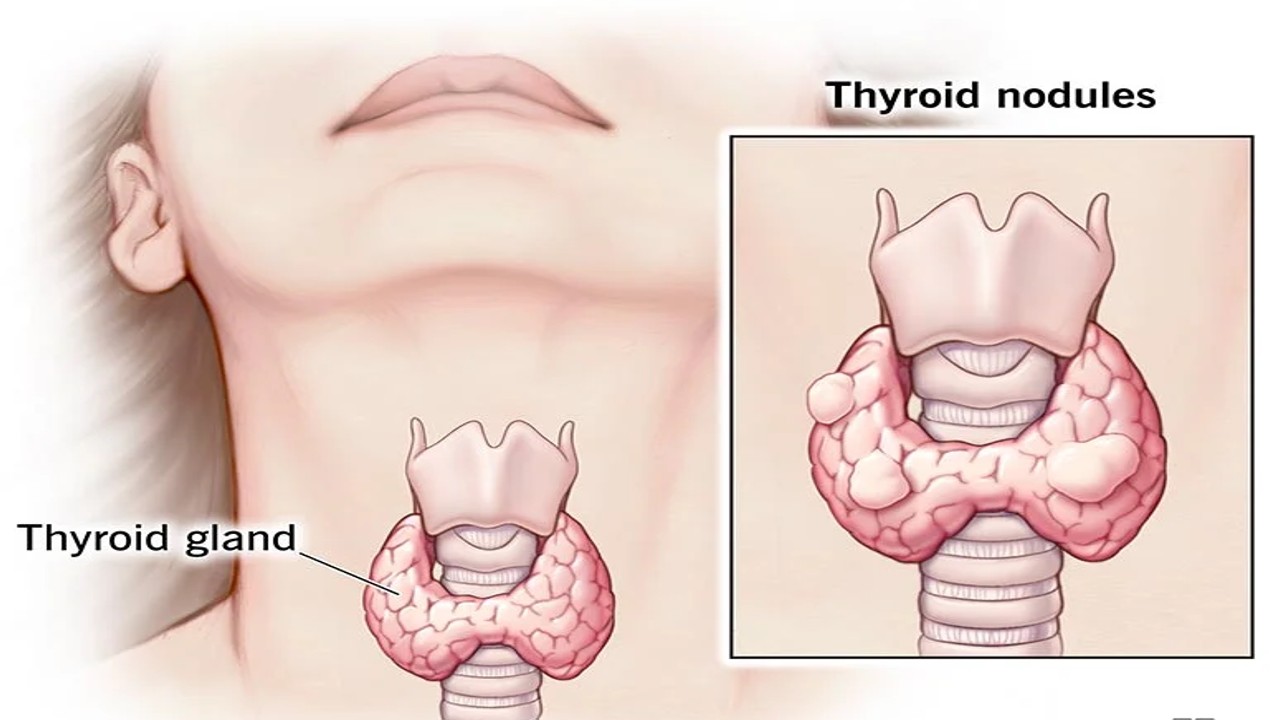 Magic foods to weight loss in thyroid 1