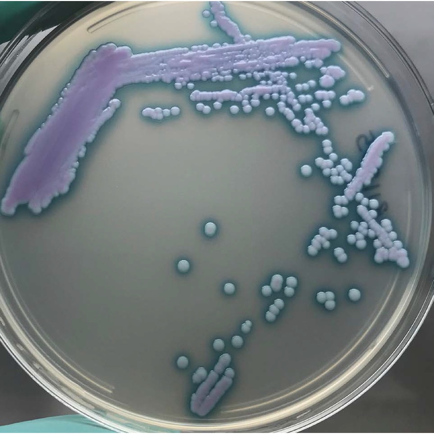 Superbug fungus Candida Auris outbreak