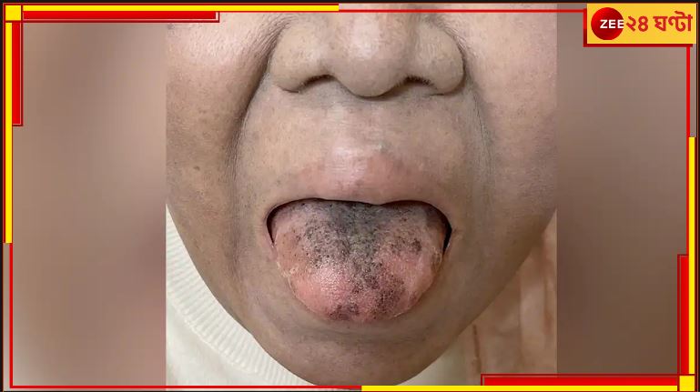 Black Tongue | Antibiotics: অ্যান্টিবায়োটিকের পার্শ্বপ্রতিক্রিয়ায় লোমশ কালো জিভ মহিলার, ধূসর ত্বক! Black Tongue | Antibiotics: অ্যান্টিবায়োটিকের পার্শ্বপ্রতিক্রিয়ায় লোমশ কালো জিভ মহিলার, ধূসর ত্বক!