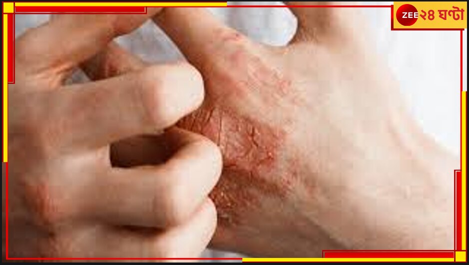 Atopic Dermatitis: ভারতের বাজারে এল চুলকানির মহৌষধ