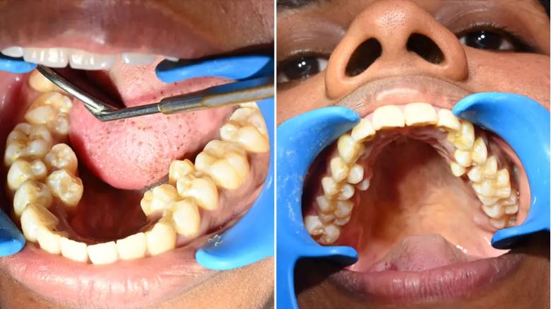 Indian Woman Highest Teeth Guinness Record