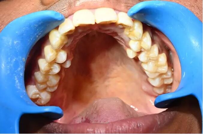 Indian Woman Highest Teeth Guinness Record