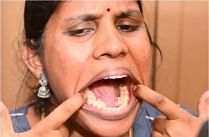Indian Woman Highest Teeth Guinness Record