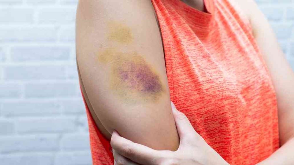 Bruise Mark: সাবধান! আঘাত ছাড়াই কালশিটে আভাস দিচ্ছে বড় রোগের... | bruise mark without any hurt suggests a major disease