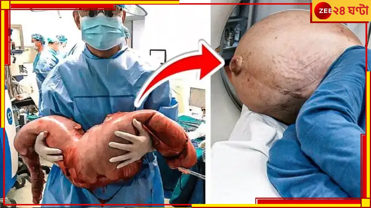 OMG: ২২ বছর ধরে পেটের ভিতর জমে ১৫ কেজি পটি! দেখতে ঠিক অজগরের বাচ্চার মত…