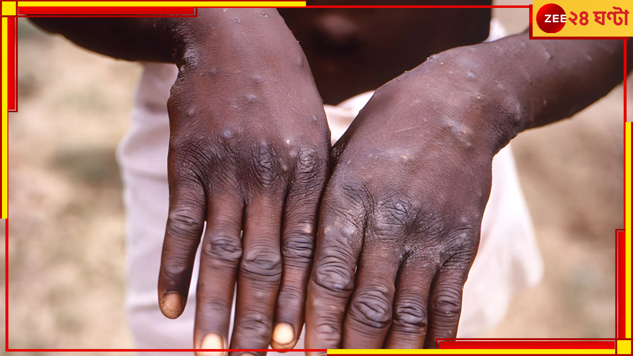 Mpox Scare: ভয়ংকর হয় উঠছে মাঙ্কিপক্স, বিশেষ নির্দেশিকা জারি এইমসের, আফ্রিকার এই দেশ মৃত ৫৭০  