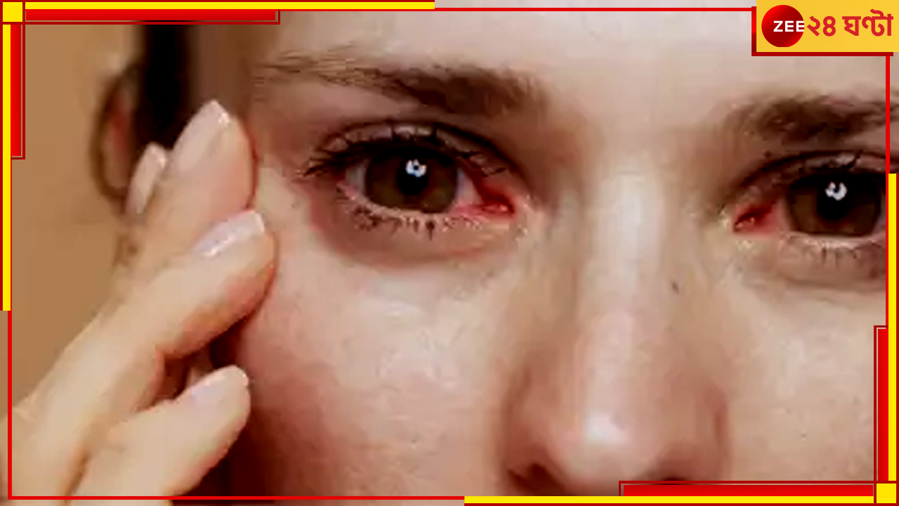 Bleeding Eye Virus: সংক্রমণের ৭ দিনের মধ্যে হতে পারে মৃত্যুও, ভয়ংকর মারবার্গ ভাইরাস নিয়ে জারি সতর্কতা Bleeding Eye Virus: সংক্রমণের ৭ দিনের মধ্যে হতে পারে মৃত্যুও, ভয়ংকর মারবার্গ ভাইরাস নিয়ে জারি সতর্কতা