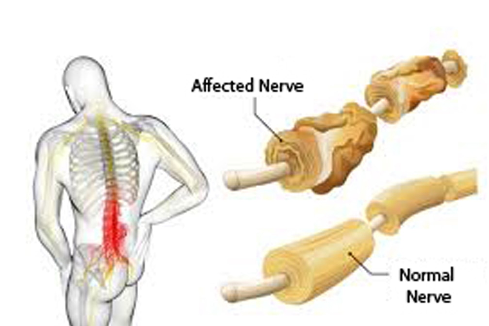 Guillain–Barre Syndrome