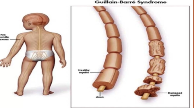 Guillain–Barre Syndrome