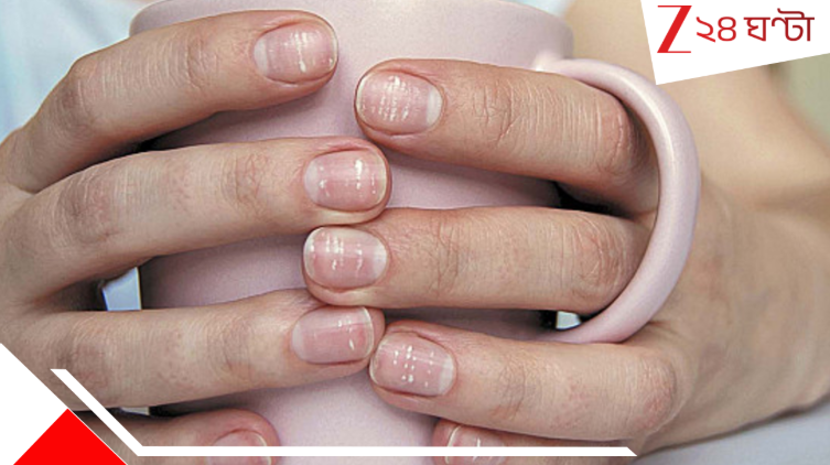 White Spot on Nails: নখে সাদা দাগ? হতে পারে বড় রোগের লক্ষণ... White Spot on Nails: নখে সাদা দাগ? হতে পারে বড় রোগের লক্ষণ...