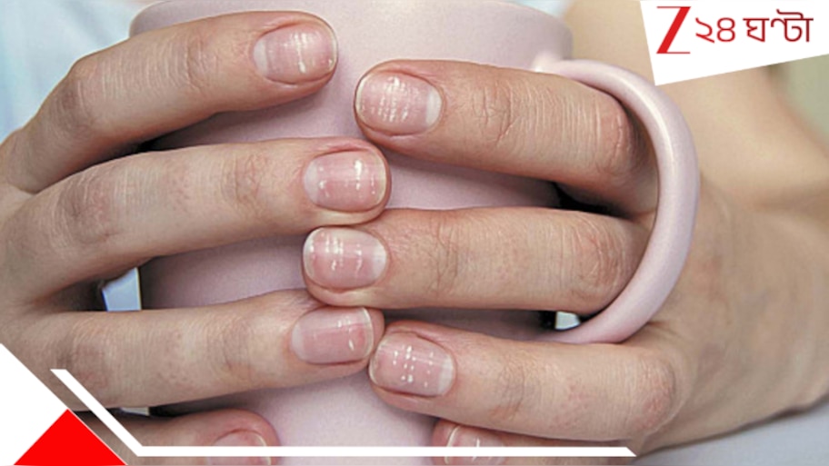 White Spot on Nails: নখে সাদা দাগ? হতে পারে বড় রোগের লক্ষণ...