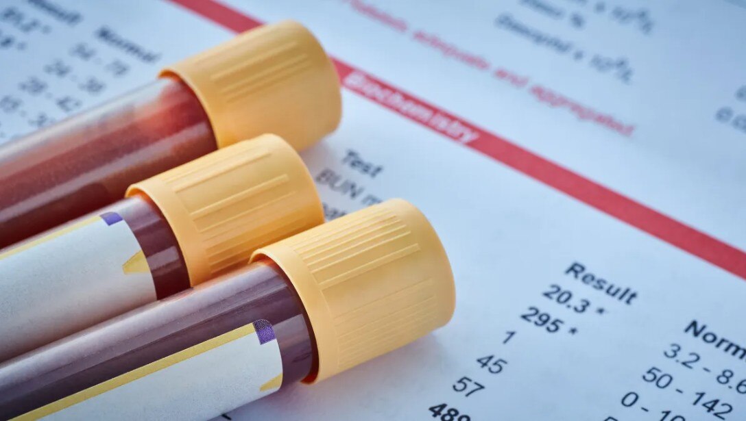 CRIB the New Blood Group Discovered in Bengaluru Woman