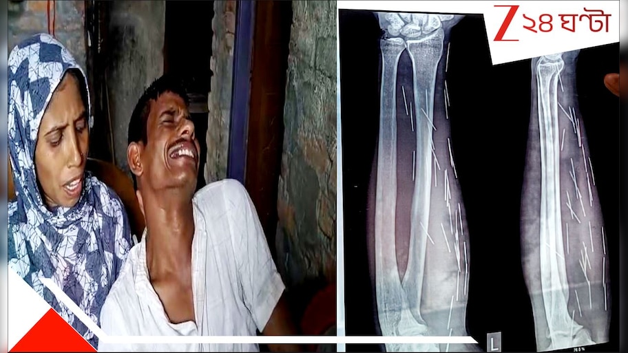 Malda Needle Man Incident: অবিশ্বাস্য! হাড়হিম! মালদহের হায়দরের পেট থেকে বেরিয়েছে ৩৭টা সুচ! রোজ জন্ম নিচ্ছে আরও অগুনতি...