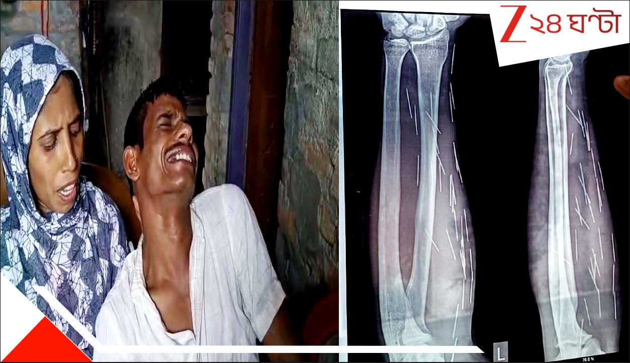 Malda Needle Man Incident: অবিশ্বাস্য! হাড়হিম! মালদহের হায়দরের পেট থেকে বেরিয়েছে ৩৭টা সুচ! রোজ জন্ম নিচ্ছে আরও অগুনতি... Malda Needle Man Incident: অবিশ্বাস্য! হাড়হিম! মালদহের হায়দরের পেট থেকে বেরিয়েছে ৩৭টা সুচ! রোজ জন্ম নিচ্ছে আরও অগুনতি...