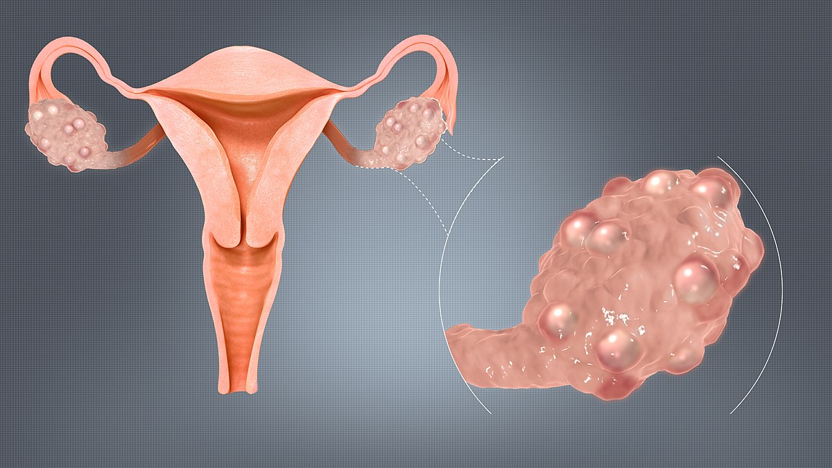 Metformin Cuts Risk Of Long COVID