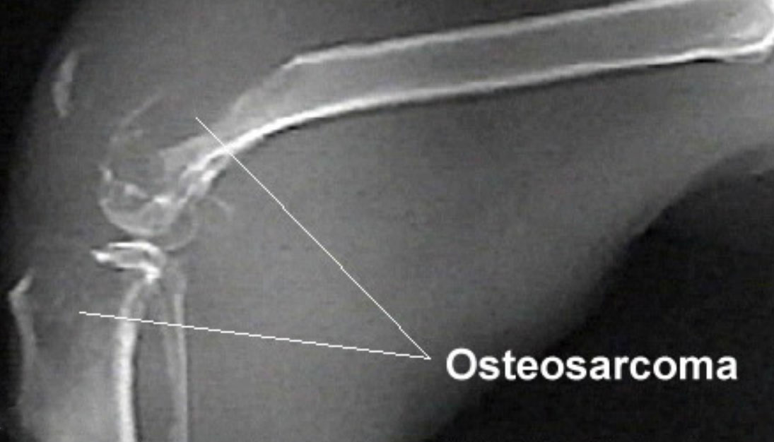 Osteosarcoma