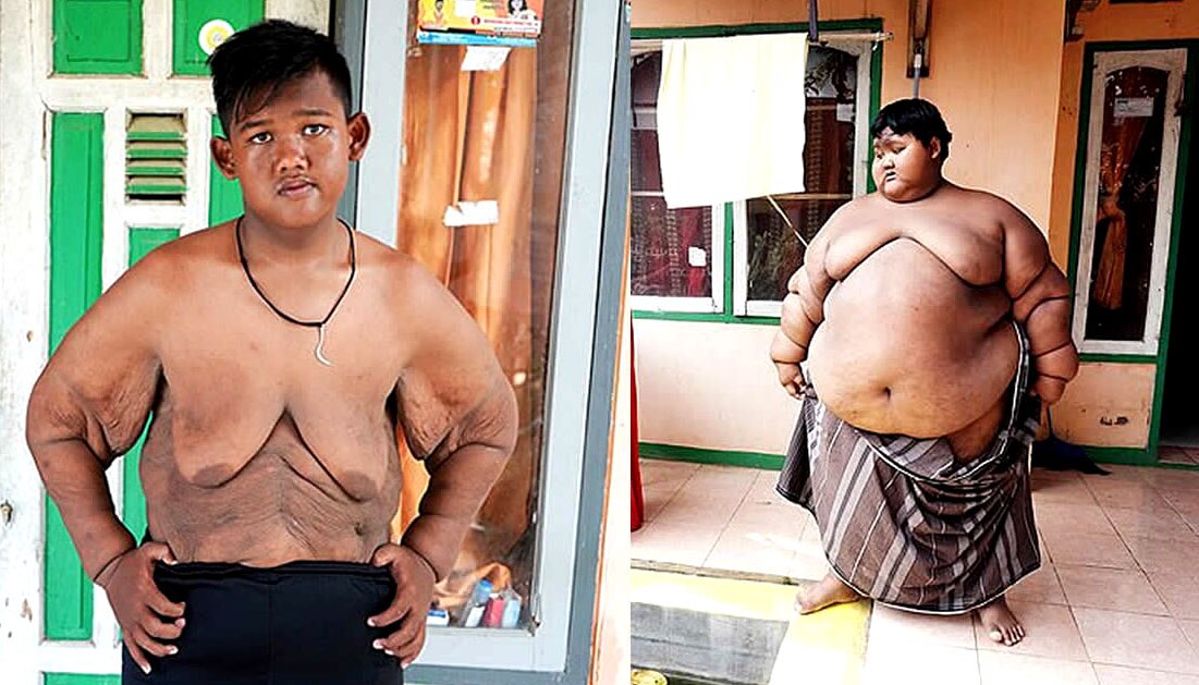 World&#039;s fattest child