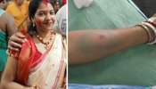 অজানা পোকার কামড়ে সবুজ বর্ণ ধারণ করে হাত, বৈদ্যবাটিতে মৃত্যু গৃহবধূর অজানা পোকার কামড়ে সবুজ বর্ণ ধারণ করে হাত, বৈদ্যবাটিতে মৃত্যু গৃহবধূর