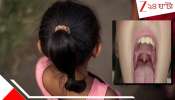 Kolkata Brave Girl: ১০ বছরের মেয়ের বন্ধ-ই হত না মুখ! বিরল অসুখে হাঁ করেই 'যন্ত্রণাময়' ৯১২ দিন... শেষে মিরাক্যল ঘটাল আর আহমেদ ডেন্টাল কলেজ...