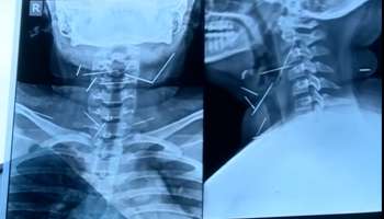 গলায় বিঁধে ১০টি সূচ, ছবি দেখলে চমকে যাবেন