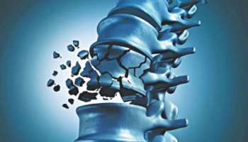 আপনার অজান্তেই এই অভ্যাসগুলি নিঃশব্দে বাড়িয়ে তুলছে অস্টিওপোরোসিসের ঝুঁকি!