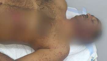 মিনাখাঁয় আক্রান্ত BJP নেতা বাবু মাস্টার, বোমা-গুলি নিয়ে হামলার অভিযোগ