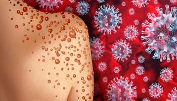 Monkeypox: রাজ্যে মাঙ্কিপক্সের প্রথম সন্দেহভাজনের খোঁজ, কলকাতায় চিকিৎসাধীন বিদেশ ফেরত তরুণ