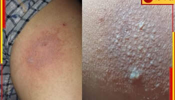 Raigung:অজানা পোকার আক্রমণে গৃহবধূর মৃত্যু, আক্রান্ত বহু! শহরে নয়া আতঙ্ক...