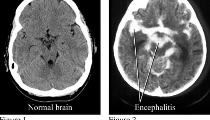এনসেফালাইটিস কী? 