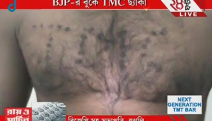 EXCLUSIVE: BJP কর্মীর বুকে সিগারেটের ছ্যাঁকা দিয়ে লেখা হল TMC 