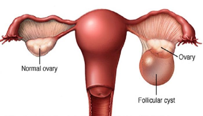 ওভারিয়ান সিস্টের উপসর্গগুলি জেনে নিন, সাবধান হোন