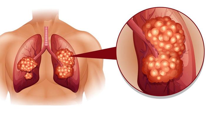 ফুসফুসের ক্যানসারের লক্ষণ এবং চিকিত্‌সা জেনে নিন