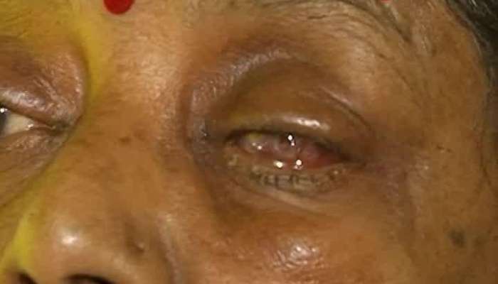 Doctor negligence infection grows from cataract operation eye has been removed completely