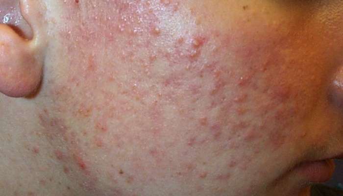 ফর্সা হওয়ার Cream মাখার আগে সতর্ক হন, হতে পারে Skin Infection