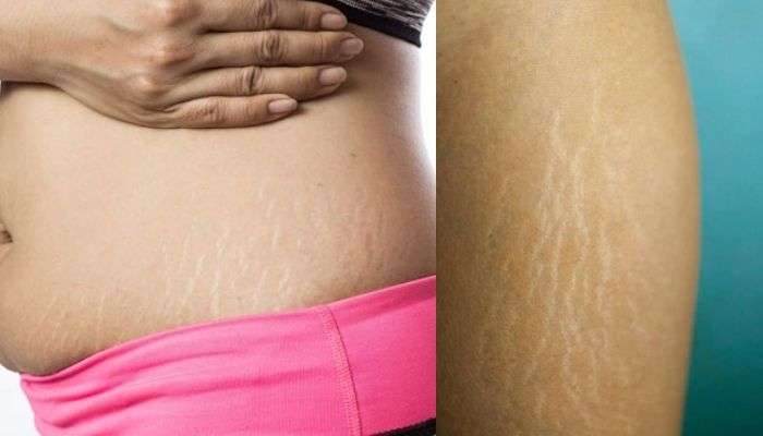 বাড়তি মেদ ঝরিয়েও চিন্তা কমছে না! Stretch marks নিয়ে নাজেহাল? জেনে নিন কয়েকটা টিপস