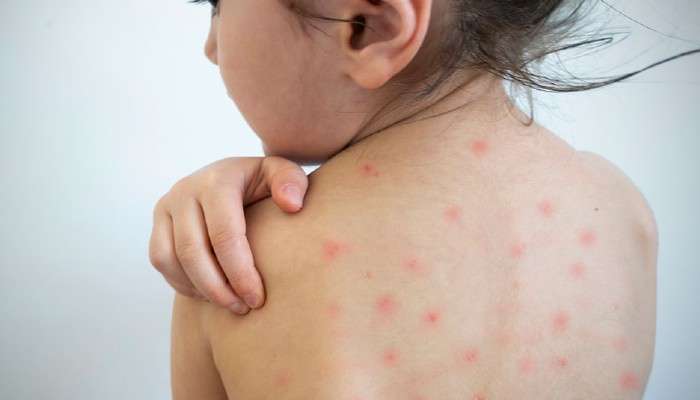 Measles: সময়টা বসন্ত, রয়েছে মিজলসের ভয়; দেখে নিন কী ভাবে সাবধানে থাকতে হবে