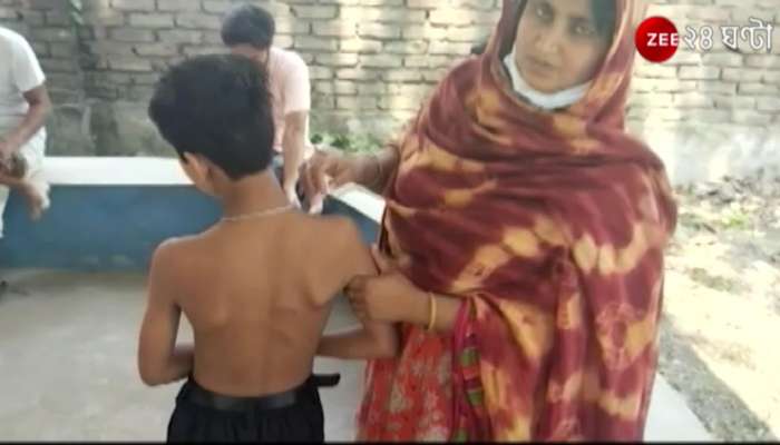 North 24 Parganas: Headmaster beats up fifth grade student, marks multiple wounds on body