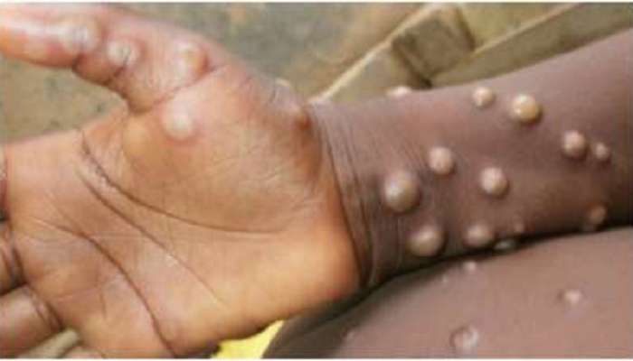 Monkeypox: যৌন মিলনেও ছড়াতে পারে মাঙ্কিপক্স, সতর্ক করছেন বিশেষজ্ঞরা